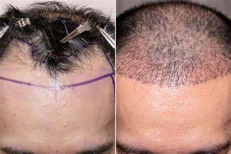 mane center for advanced hair restoration